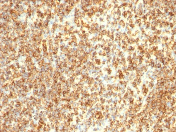 Formalin-fixed, paraffin-embedded human Lymphoma stained with CD20 Monoclonal Antibody (L26 + IGEL/773)