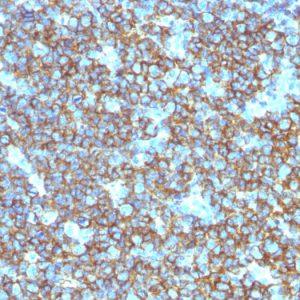 Formalin-fixed, paraffin-embedded human Tonsil stained with CD20 Rabbit Polyclonal Antibody.