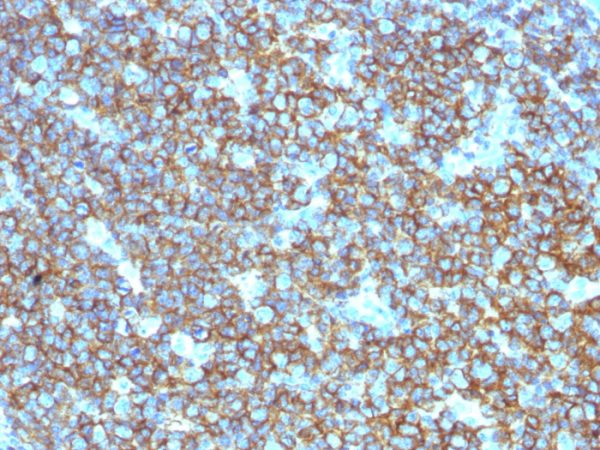 Formalin-fixed, paraffin-embedded human Tonsil stained with CD20 Rabbit Polyclonal Antibody.
