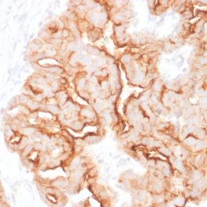 Formalin-fixed, paraffin-embedded human Ovarian Carcinoma stained with MUC16 Mouse Monoclonal Antibody (MUC16/1860).