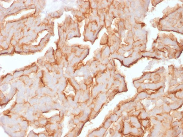 Formalin-fixed, paraffin-embedded human Ovarian Carcinoma stained with MUC16 Mouse Monoclonal Antibody (OCA125/1900).