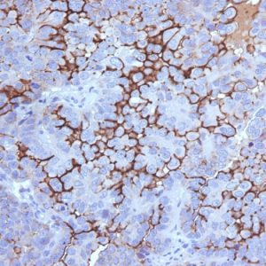 Formalin-fixed, paraffin-embedded human Ovarian Carcinoma stained with MUC16 Mouse Monoclonal Antibody (5E11). Courtesy of Dr. Leonor David, IPATIMUP and Medical Faculty University of Porto, Portugal.