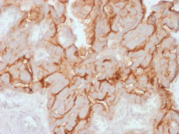 Formalin-fixed, paraffin-embedded human Ovarian Carcinoma stained with MUC16 Rabbit Recombinant Monoclonal Antibody (OCA125/2349R).