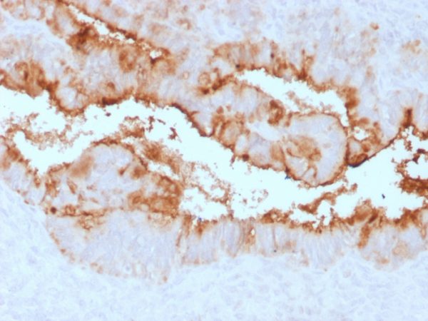 Formalin-fixed, paraffin-embedded human Endometrial Carcinoma stained with MUC16 Rabbit Recombinant Monoclonal Antibody (OCA125/2349R).