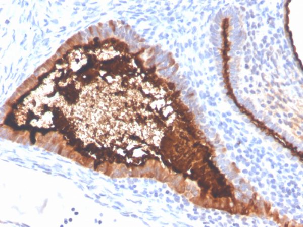 Formalin-fixed, paraffin-embedded human ovarian carcinoma stained with MUC16 Recombinant Rabbit Monoclonal Antibody (OCA125/4505R).