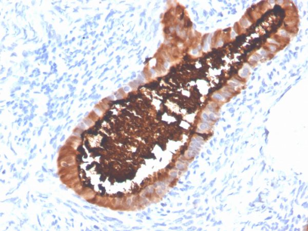 Formalin-fixed, paraffin-embedded human ovarian carcinoma stained with MUC16 Recombinant Rabbit Monoclonal Antibody (OCA125/4505R).