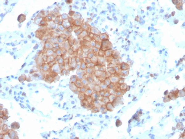 Formalin-fixed, paraffin-embedded human lung carcinoma stained with CD86-Monospecific Mouse Monoclonal Antibody (C86/3711).