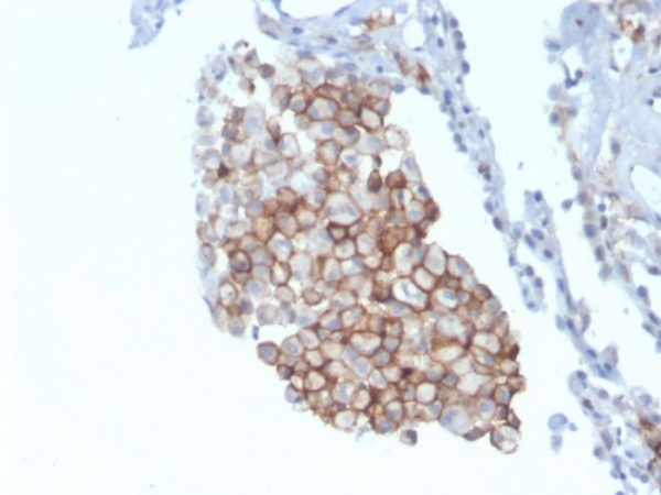 Formalin-fixed, paraffin-embedded human lung carcinoma stained with CD86-Monospecific Mouse Monoclonal Antibody (C86/3711).