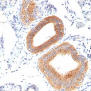 Formalin-fixed, paraffin-embedded human Melanoma stained with CD86 Mouse Monoclonal Antibody (C86/1146).