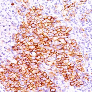 Formalin-fixed, paraffin-embedded human Hodgkin&apos;s lymphoma stained with CD30 Ab (CD30/412).