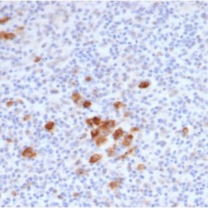 IHC analysis of formalin-fixed, paraffin-embedded human Hodgkin&apos;s lymphoma. Saining of Reed-Sternberg cells using rKi-1/6913 at 2ug/ml in PBS for 30min RT. HIER: Tris/EDTA, pH9.0, 45min. 2°C: HRP-polymer, 30min. DAB, 5min.