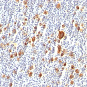 Formalin-fixed, paraffin-embedded human Hodgkin&apos;s Lymphoma stained with CD30 Monoclonal Antibody (Ber-H2).