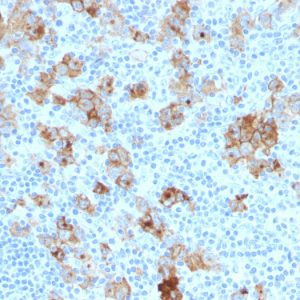 Formalin-fixed, paraffin-embedded human Hodgkin&apos;s Lymphoma stained with CD30 Monoclonal Antibody (SPM121).