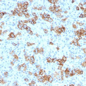 Formalin-fixed, paraffin-embedded human Hodgkin&apos;s Lymphoma stained with CD30 Monoclonal Antibody (Ki-1/779).