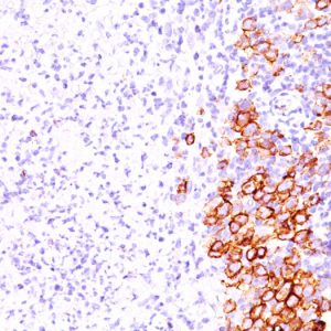 Formalin-fixed, paraffin-embedded human Hodgkin&apos;s Lymphoma stained with CD30 Monoclonal Antibody (SPM609).
