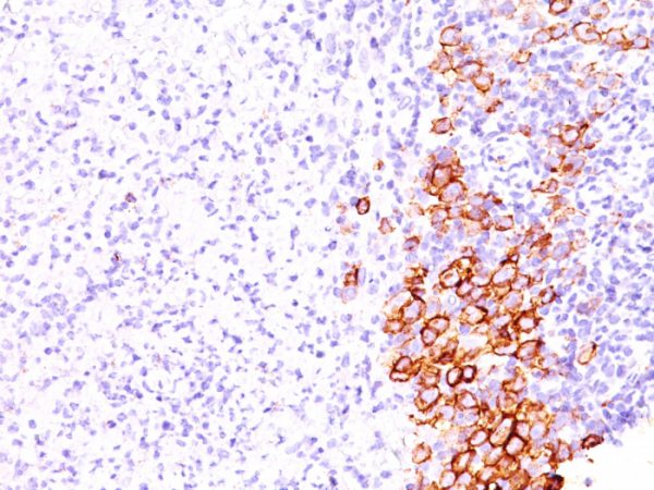 Formalin-fixed, paraffin-embedded human Hodgkin&apos;s Lymphoma stained with CD30 Monoclonal Antibody (SPM609).