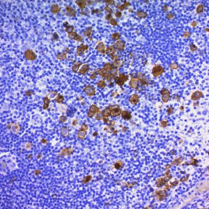Formalin-fixed, paraffin-embedded human Hodgkin&apos;s Lymphoma stained with CD30 Monoclonal Antibody (Ber-H2 + CD30/412).