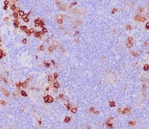 IHC analysis of formalin-fixed, paraffin-embedded human Hodgkin&apos;s lymphoma. Cytoplasmic and membranous staining using Ki-1/4399R at 2ug/ml in PBS for 30min RT. HIER: Tris/EDTA, pH9.0, 45min. 2 °: HRP-polymer, 30min. DAB, 5min.