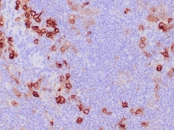IHC analysis of formalin-fixed, paraffin-embedded human Hodgkin's lymphoma. Cytoplasmic and membranous staining using Ki-1/4399R at 2ug/ml in PBS for 30min RT. HIER: Tris/EDTA, pH9.0, 45min. 2 °: HRP-polymer, 30min. DAB, 5min. Recombinant CD30 / TNFRSF8 (Hodgkin & Reed-Sternberg Cell Marker) Antibody