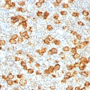 Formalin-fixed, paraffin-embedded human Hodgkin&apos;s Lymphoma stained with CD30 Rabbit Recombinant Monoclonal Antibody (Ki-1/1505R).