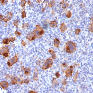 Formalin-fixed, paraffin-embedded human Hodgkin&apos;s Lymphoma stained with CD30 Rabbit Recombinant Monoclonal Antibody (Ki-1/1747R).