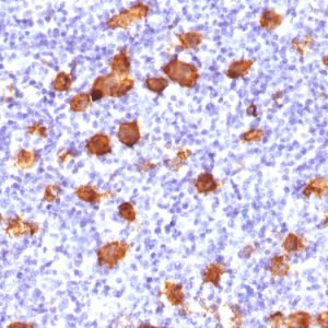 Formalin-fixed, paraffin-embedded human Hodgkin&apos;s Lymphoma stained with CD30 Rabbit Polyclonal Antibody.