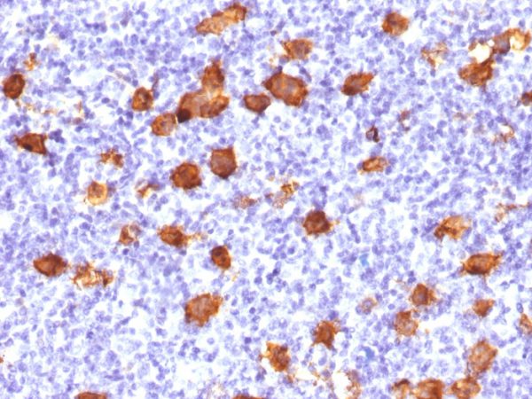 Formalin-fixed, paraffin-embedded human Hodgkin&apos;s Lymphoma stained with CD30 Rabbit Polyclonal Antibody.