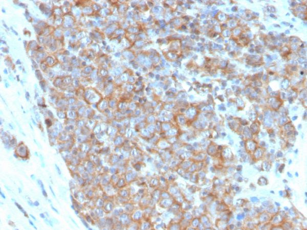 Formalin-fixed, paraffin-embedded human urothelial carcinoma stained with CD33 Mouse Monoclonal Antibody (SIGLEC3/3600).