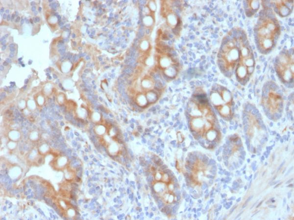 Formalin-fixed, paraffin-embedded human colon carcinoma stained with CD33 Mouse Monoclonal Antibody (SIGLEC3/3600).
