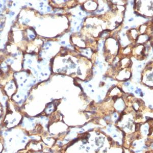 Formalin-fixed, paraffin-embedded human Angiosarcoma stained with CD34 Monoclonal Antibody (HPCA1/1171)