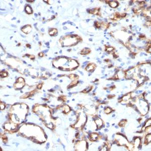 Formalin-fixed, paraffin-embedded human Angiosarcoma stained with CD34 Monoclonal Antibody (SPM610)