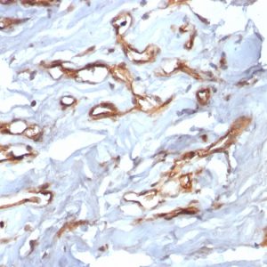 Formalin-fixed, paraffin-embedded human Angiosarcoma stained with CD34 Recombinant Rabbit Monoclonal Antibody (HPCA1/2598R).