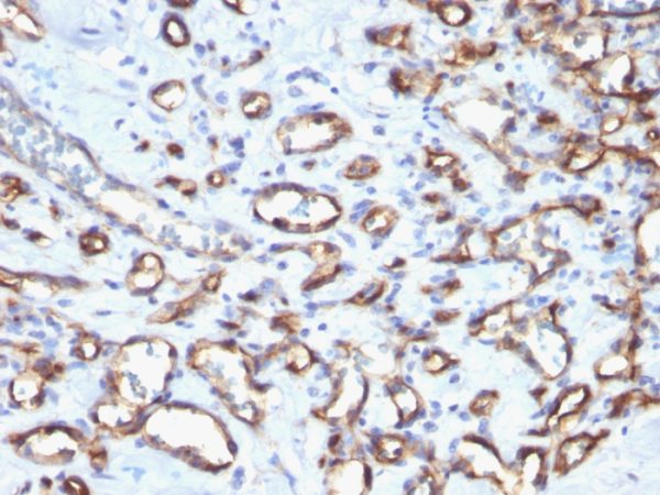 Formalin-fixed, paraffin-embedded human Angiosarcoma stained with CD34 Rabbit Polyclonal Antibody.