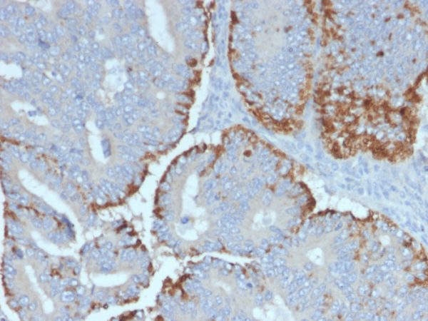 Formalin-fixed, paraffin-embedded human Colon Carcinoma stained with ATG5 Mouse Monoclonal Antibody (ATG5/2492).