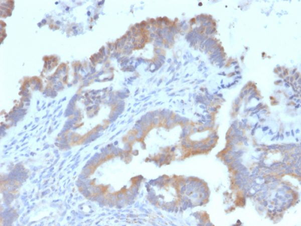 Formalin-fixed, paraffin-embedded human Endometrial Carcinoma stained with ATG5 Mouse Monoclonal Antibody (ATG5/2492).