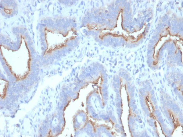 Formalin-fixed, paraffin-embedded human Ovarian Carcinoma stained with ATG5 Mouse Monoclonal Antibody (ATG5/2492).