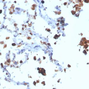 Formalin-fixed, paraffin-embedded human Lung Adenocarcinoma stained with Napsin A Mouse Monoclonal Antibody (NAPSA/3308).