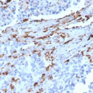 Formalin-fixed, paraffin-embedded human Lung Adenocarcinoma stained with Napsin A Mouse Monoclonal Antibody (NAPSA/3309).