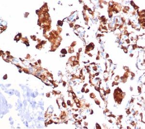 Formalin-fixed, paraffin-embedded human lung adenocarcinoma stained with Napsin A Recombinant Mouse Monoclonal Antibody (rNAPSA/6926). Inset: PBS instead of primary antibody, secondary negative control.