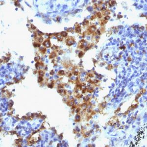 Formalin-fixed, paraffin-embedded human Lung Adenocarcinoma stained with Napsin-A Monoclonal Antibody (NAPSA/1238 + NAPSA/1239).
