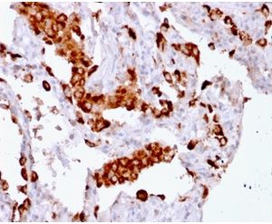 Formalin-fixed, paraffin-embedded human Lung Adenocarcinoma stained with Napsin A Mouse Recombinant Monoclonal Antibody (rNAPSA/1239).