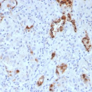 Formalin-fixed, paraffin-embedded human Lung Adenocarcinoma stained with Napsin A Mouse Monoclonal Antibody (NAPSA/3307).