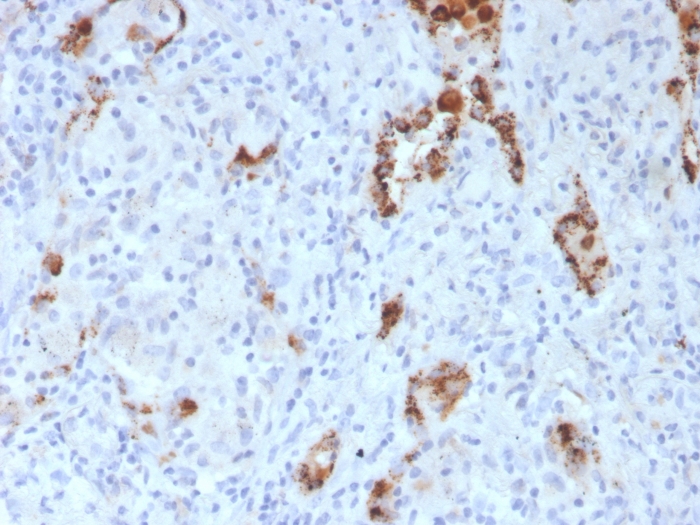 Formalin-fixed, paraffin-embedded human Lung Adenocarcinoma stained with Napsin A Mouse Monoclonal Antibody (NAPSA/3307). Napsin A (Lung Adenocarcinoma Marker) Antibody