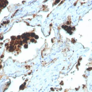 IHC analysis of formalin-fixed, paraffin-embedded human lung adenocarcinoma. NAPSA/4400R at 2ug/ml in PBS for 30min RT. HIER: Tris/EDTA, pH9.0, 45min. 2 °: HRP-polymer, 30min. DAB, 5min.