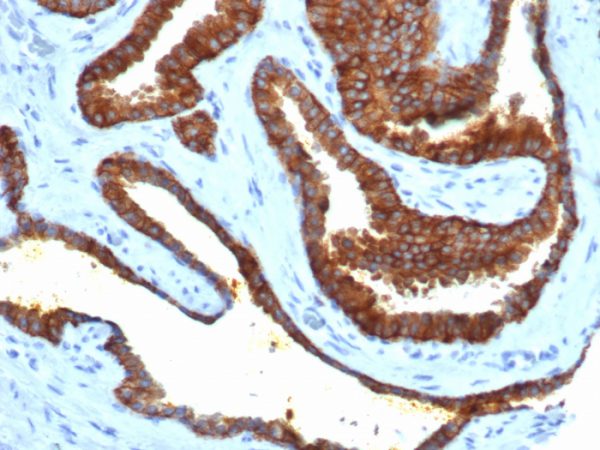 IHC analysis of formalin-fixed, paraffin-embedded human prostate adenocarcinoma. Strong cytoplasmic and membranous staining using rCD38/6447 at 2ug/ml in PBS for 30min RT. HIER: Tris/EDTA, pH9.0, 45min. 2°C: HRP-polymer, 30min. DAB, 5min.
