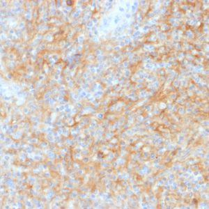 Formalin-fixed, paraffin-embedded human Hodgkin‚Äôs Lymphoma stained with CD40 Mouse Monoclonal Antibody (C40/1605).