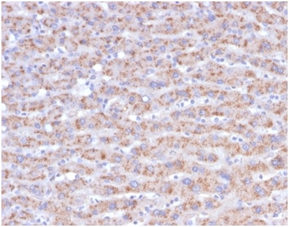 Formalin-fixed, paraffin-embedded human liver carcinoma in colon stained with CD40L-Monospecific Mouse Monoclonal Antibody (CD40LG/4675)at 2ug/ml. HIER: Tris/EDTA, pH9.0, 45min. 2°C: HRP-polymer, 30min. DAB, 5min.