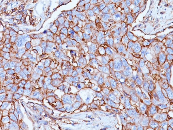 Formalin-fixed, paraffin-embedded human Breast Carcinoma stained with CD44 Mouse Monoclonal Antibody (156-3C11).