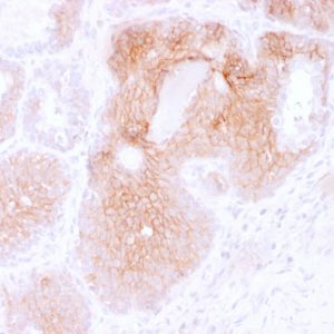 Formalin-fixed, paraffin-embedded human Prostate Carcinoma stained with CD44v6 Mouse Monoclonal Antibody (2F10).