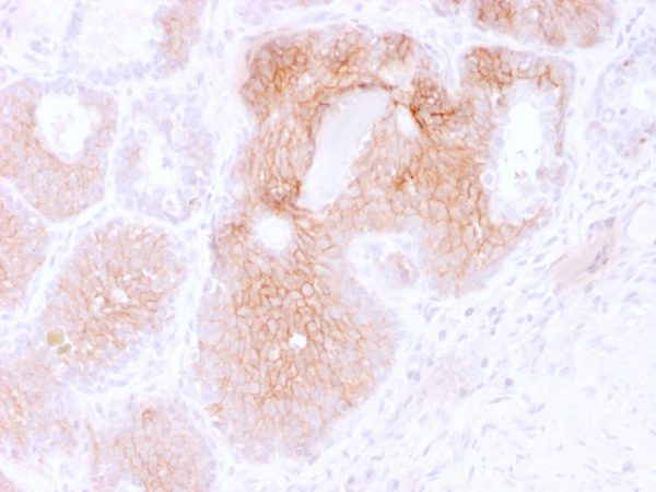 Formalin-fixed, paraffin-embedded human Prostate Carcinoma stained with CD44v6 Mouse Monoclonal Antibody (2F10).